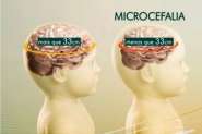 Microcefalia: estado de emergncia