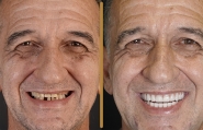 Fotos mostram antes e depois do sorriso de dono de abrigo de animais de Gaspar