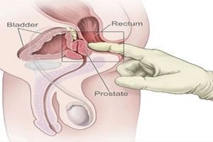 prostata11MD.jpg