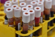 Gaspar segue com seis casos suspeitos de coronavrus e continua aguardando resultados do laboratrio