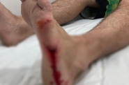 Surfista pode ter sido mordido por tubaro na praia de Navegantes