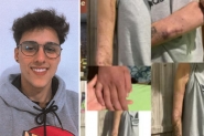 Jovem de Gaspar pede ajuda para realizar cirurgia de urgência e voltar a movimentar o braço