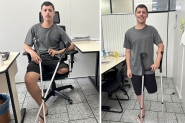 Jovem de Gaspar que teve perna amputada após câncer pede apoio para comprar prótese