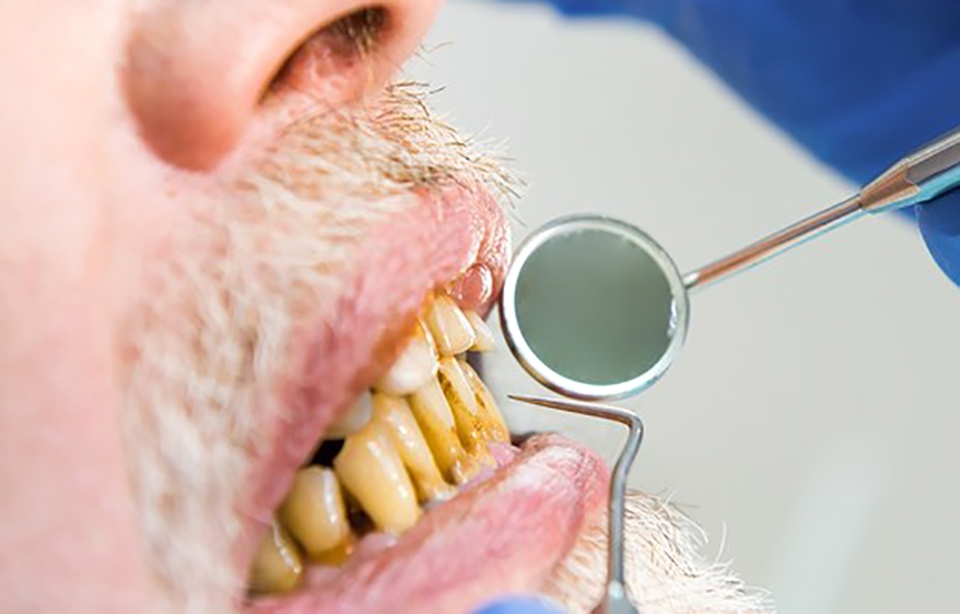 Saúde bucal e doenças do coração: entenda o risco de infarto e a saúde dos seus dentes